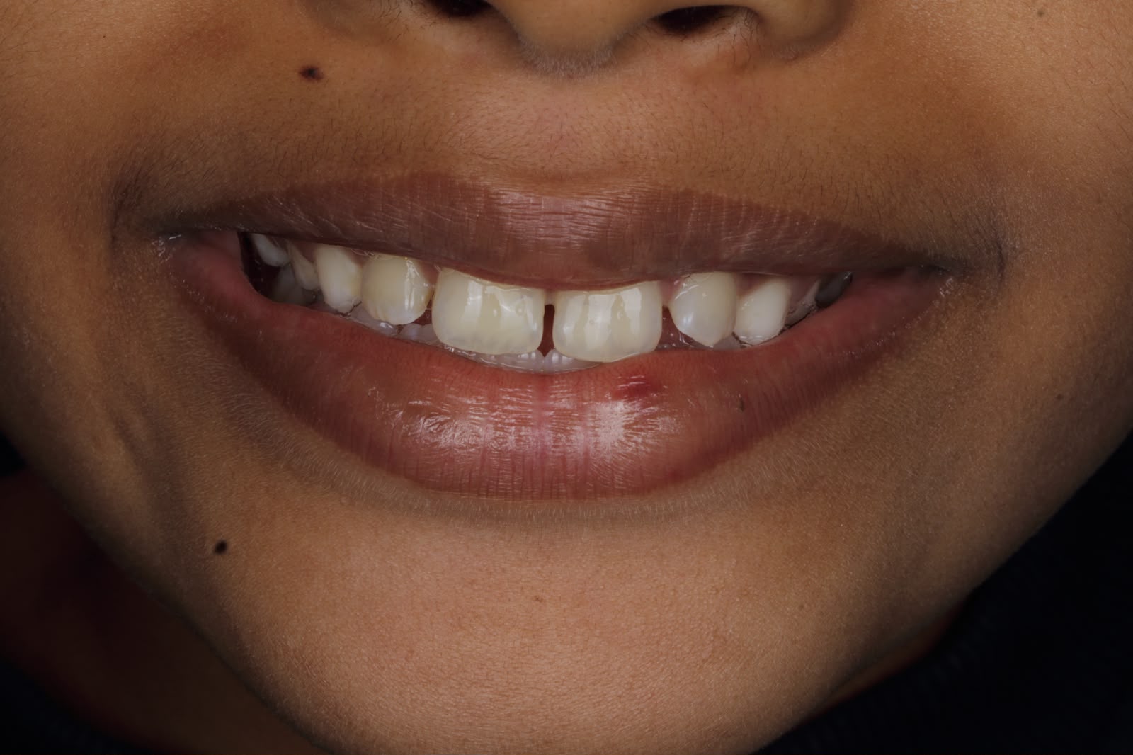After - Gap Closure