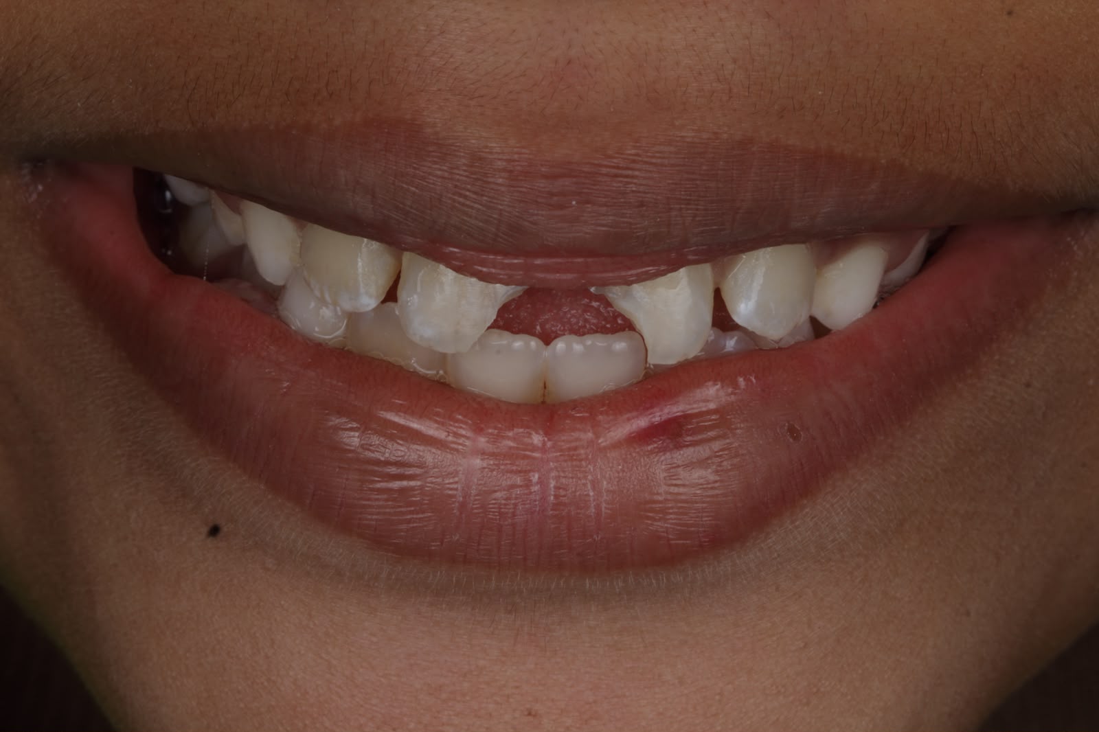 Before - Gap Closure