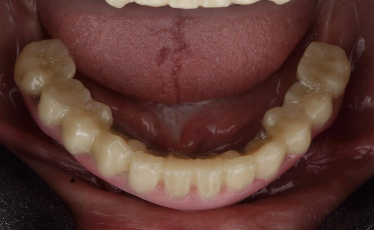 After - Implant Restoration