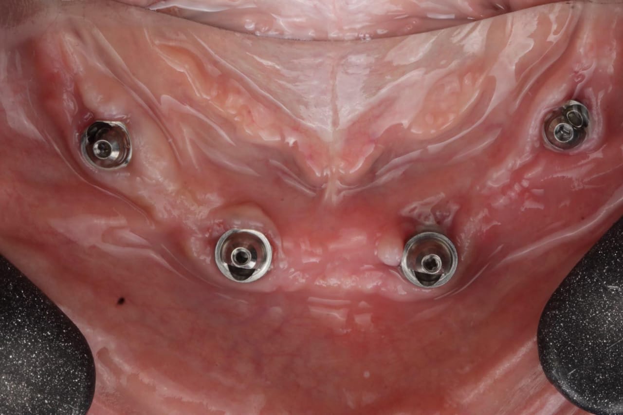 Before - Implant Placement